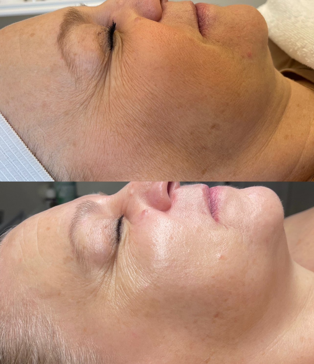 A side-by-side comparison of a woman's face before and after a skincare or cosmetic treatment, showing smoother and more even skin tone in the after image.