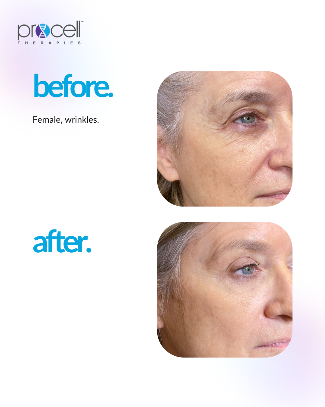 Before and after images showing a woman's face with wrinkles, demonstrating the effects of a skincare treatment by Procell Therapies.