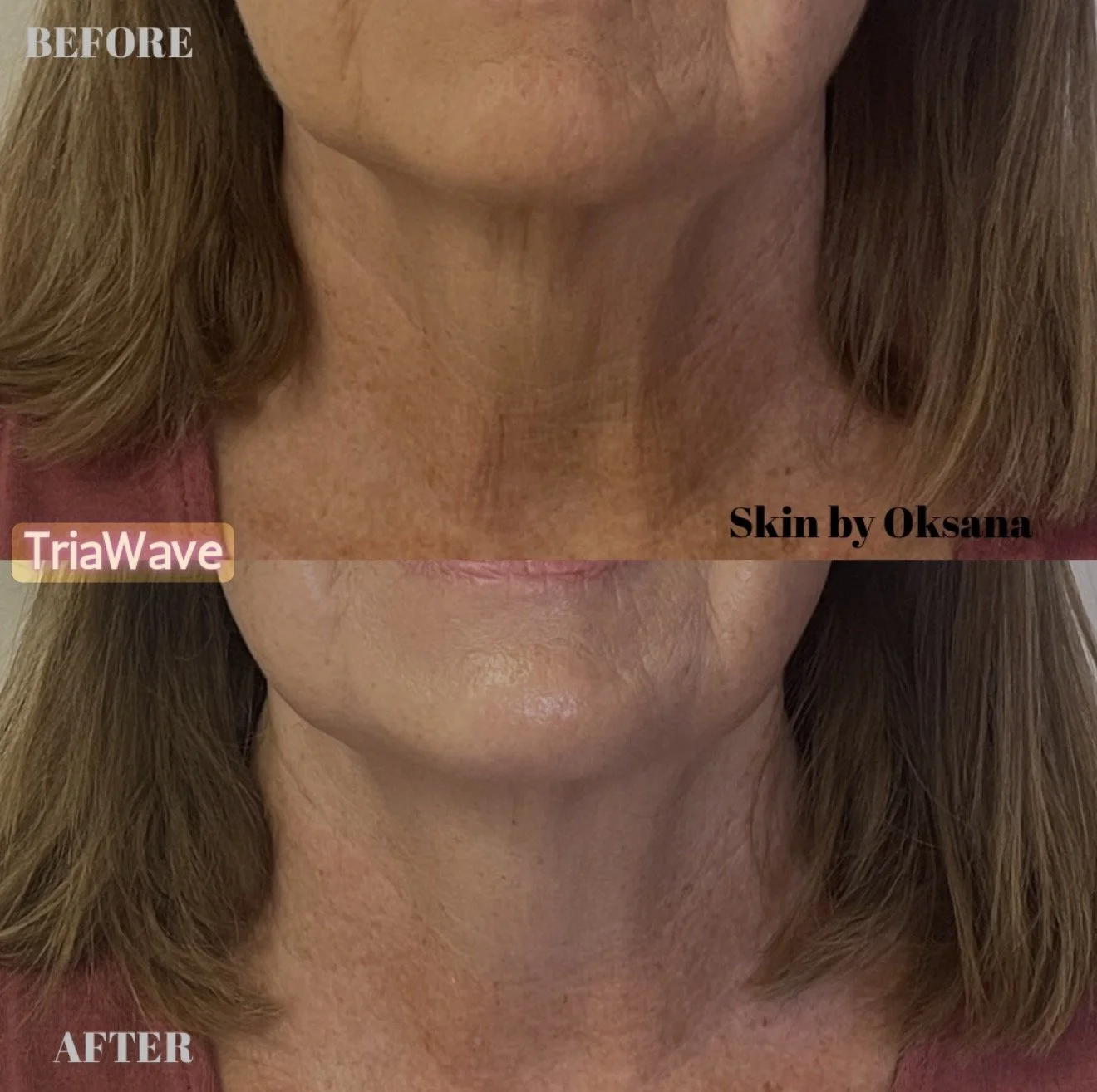 Before and after comparison of a woman's neck and lower face showing skin improvement after treatment by Oksana, with the top labeled 'BEFORE' and the bottom labeled 'AFTER', both images including text 'TriaWave' and 'Skin by Oksana'.