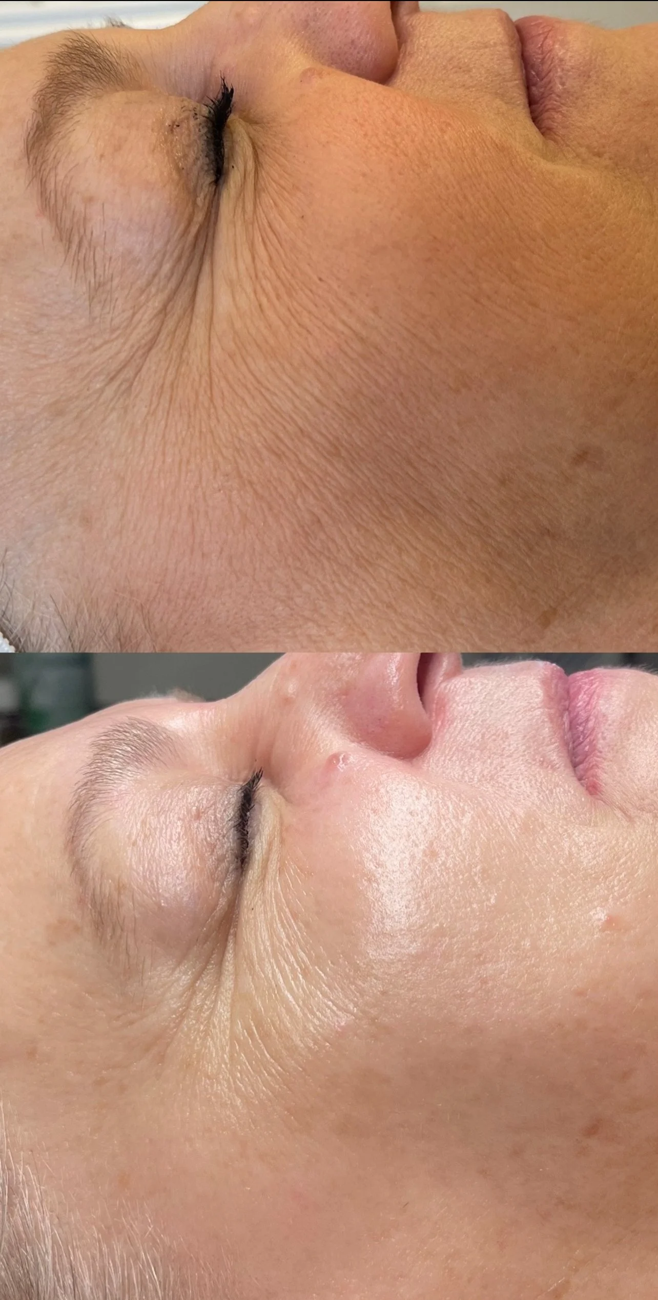 Close-up of a woman's face showing a before and after comparison of skin with reduced wrinkles after skincare treatment.