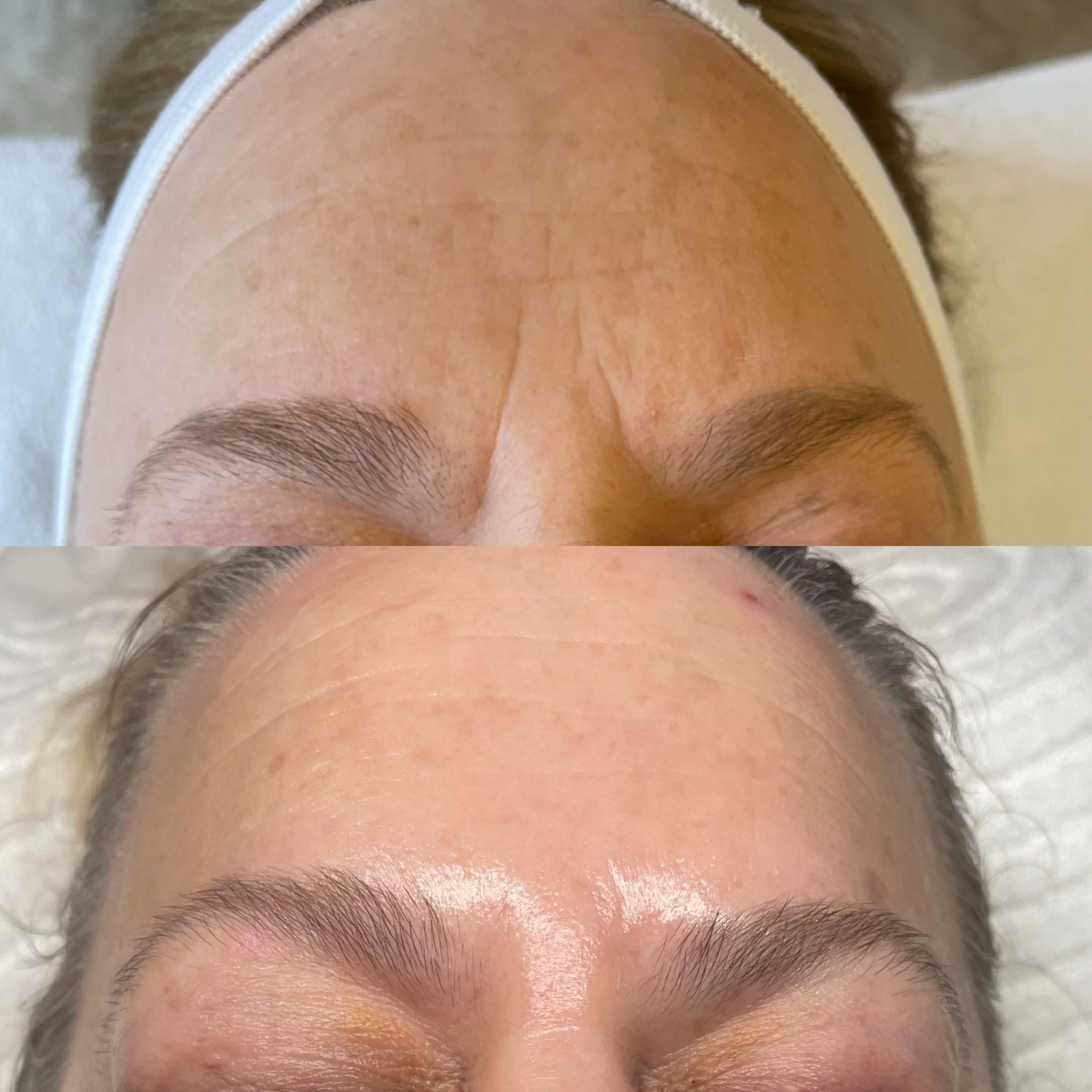 Close-up photos of a person's forehead before and after a cosmetic procedure, showing reduction in wrinkles and smoother skin.