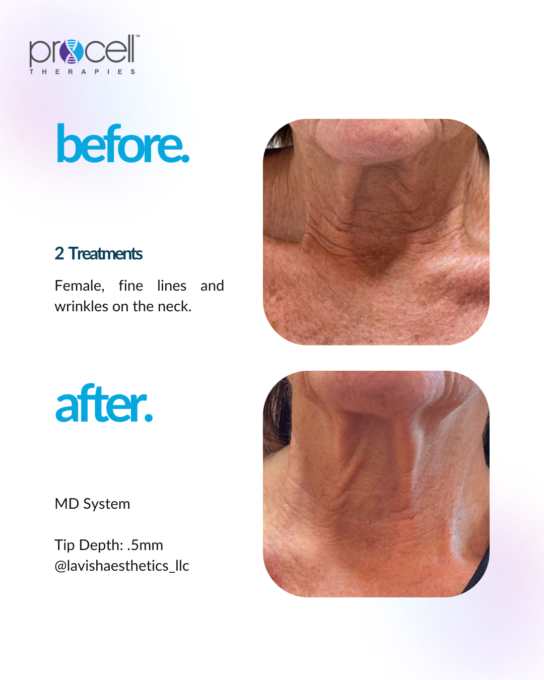 Side-by-side comparison of a woman's neck before and after 2 treatments with the MD System, showing reduced fine lines and wrinkles.