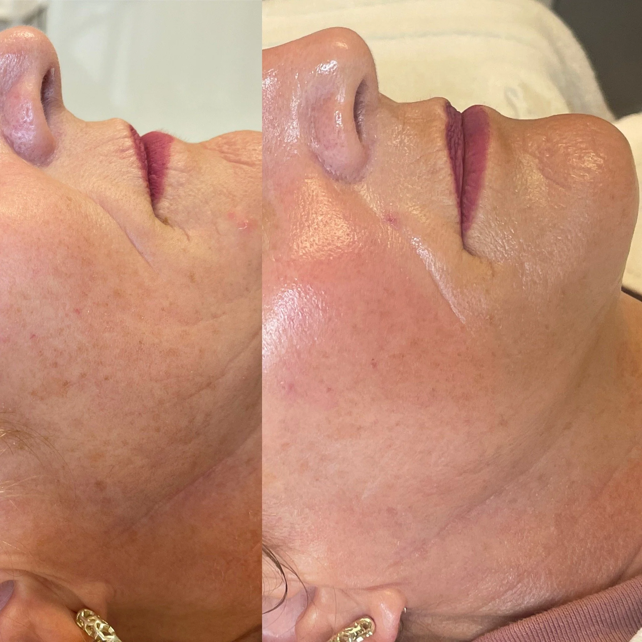 Comparison of a woman's face showing improvement in skin texture, appearance of pores and reduction of blemishes after skincare treatment.