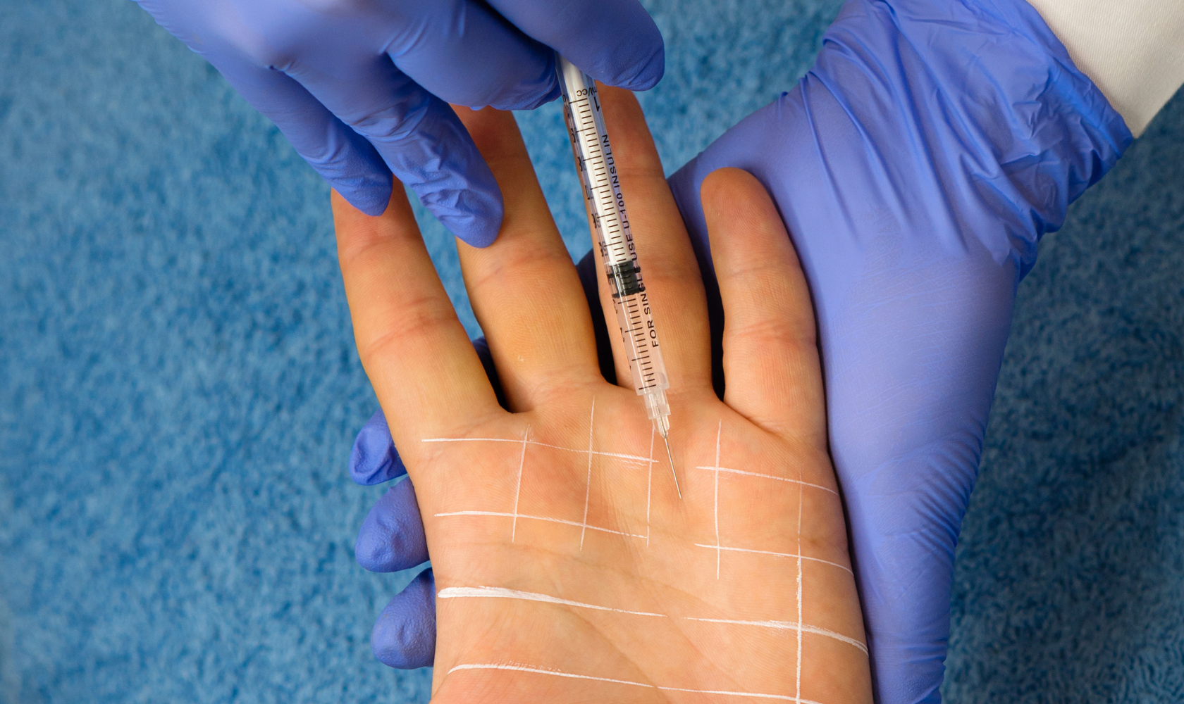 Medspa in Independence, OH, 44131 | Hyperhidrosis Treatment Near Me