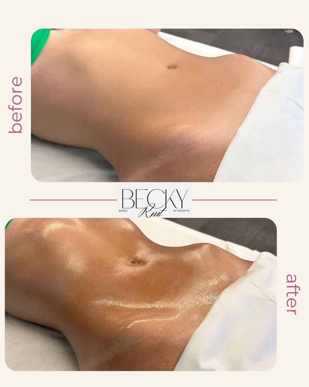 Before &amp; after Brazilian Lymphatic Drainage ✨

Designed to support fluid movement, reduce visible swelling, and enhance natural contours.

Results may vary.
📍 North York, Toronto