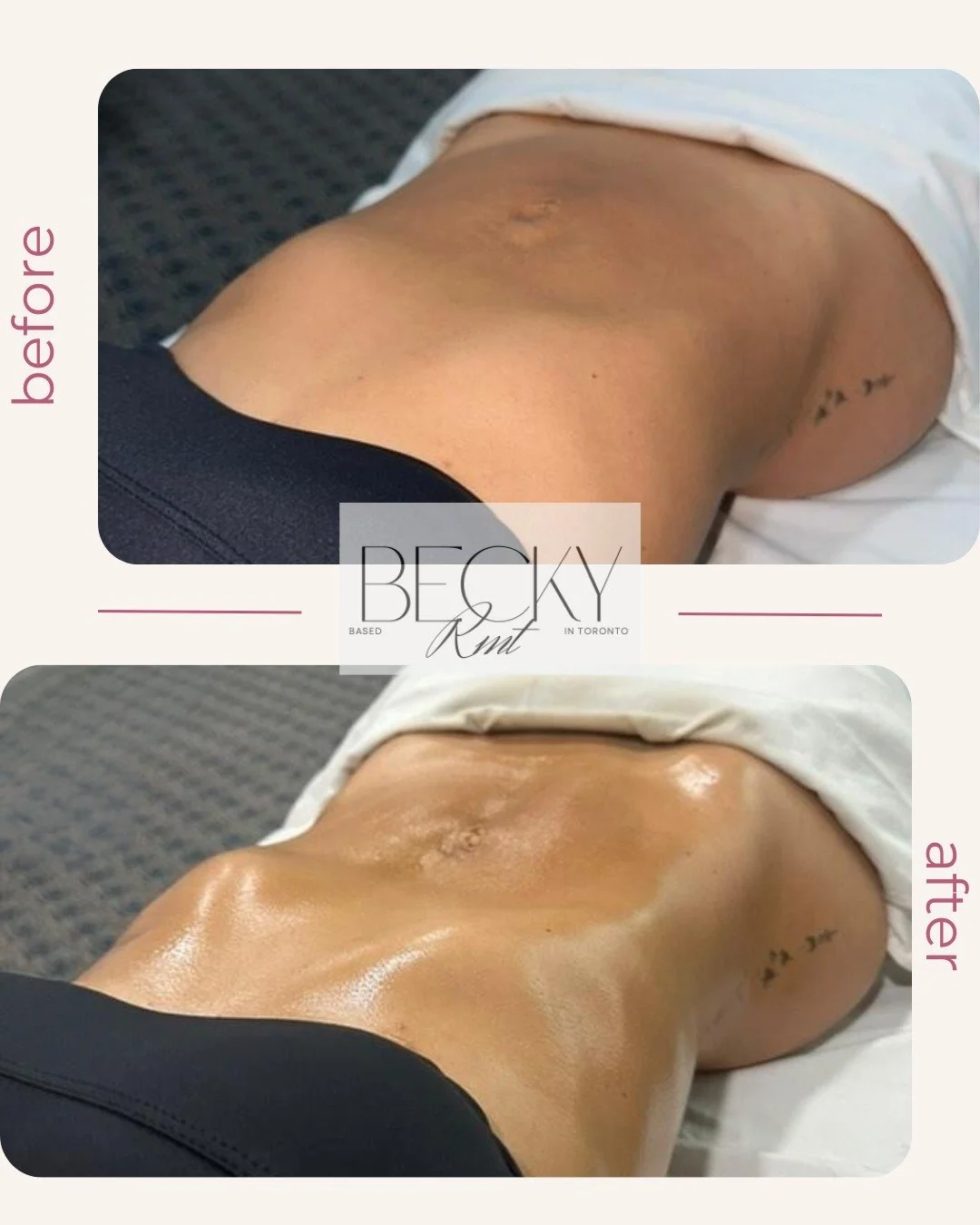 Brazilian Lymphatic Drainage ✨
Supporting fluid balance and refined contours.

Results may vary.

#Renata #LymphaticDrainage
#TorontoRMT