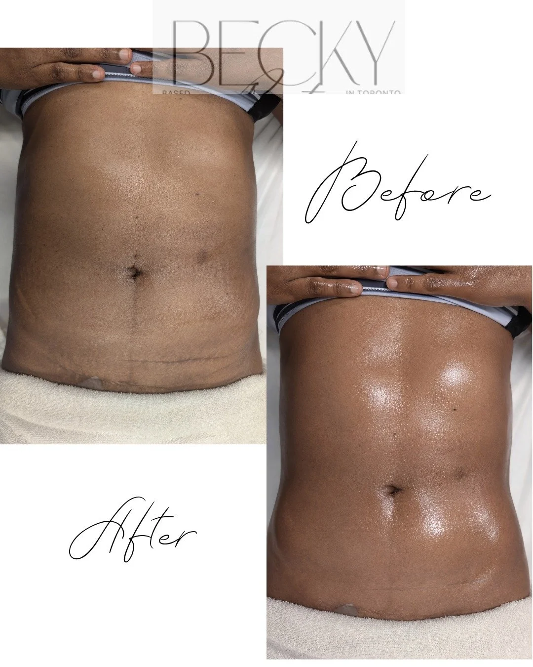 58 years old.
2 C-sections.
15 years later.

The body still responds.

This is not about age.
It&rsquo;s about circulation, fluid movement, and tissue care.