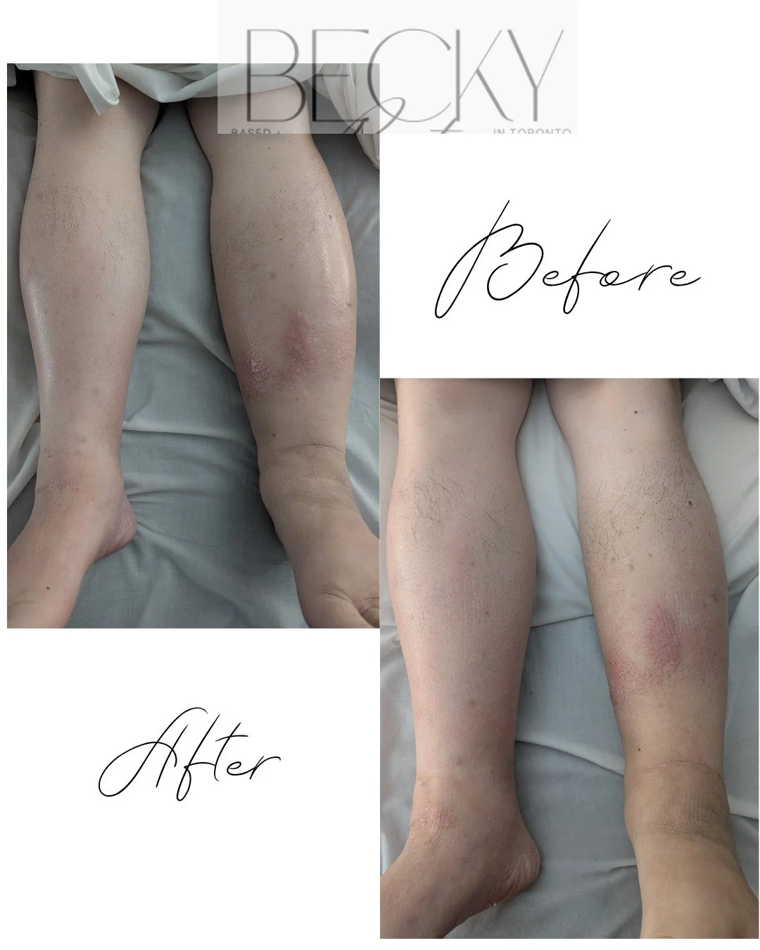 Lymphedema is a chronic condition where lymph fluid is not draining efficiently, leading to swelling, heaviness, tightness, and tissue changes over time.

One common visual sign of swelling can be skin that appears shiny or glossy. This often happens