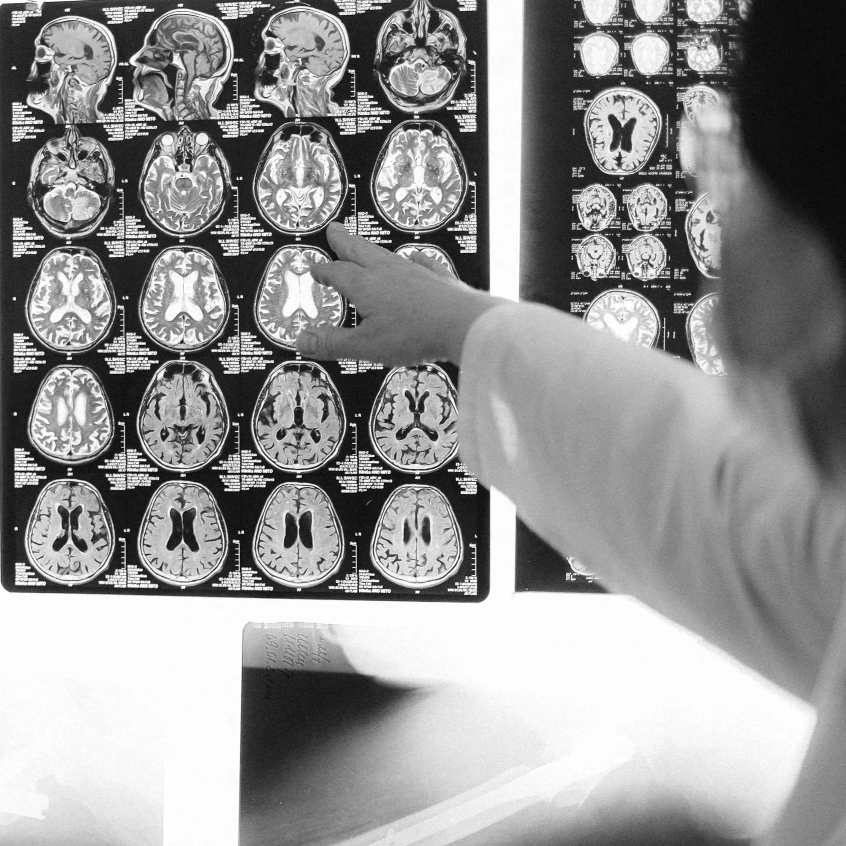 A person, possibly a medical professional, examining brain MRI scans displayed on a lightbox, with their hand pointing to a specific scan.