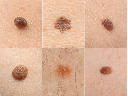 Six close-up images of skin moles and blemishes, showing different sizes, shapes, and colors.