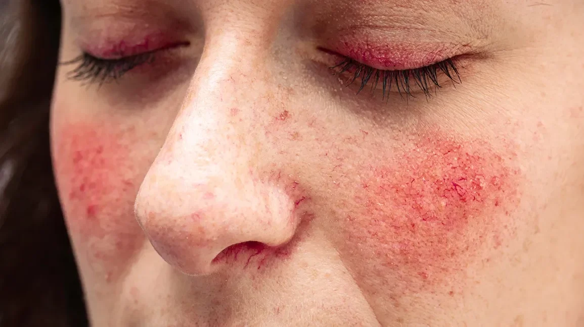 Close-up of a person's face with rosacea, irritated skin around the cheeks and nose, and pink eyelids.