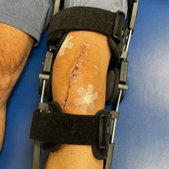 Post OCA surgery with my new equipment. 