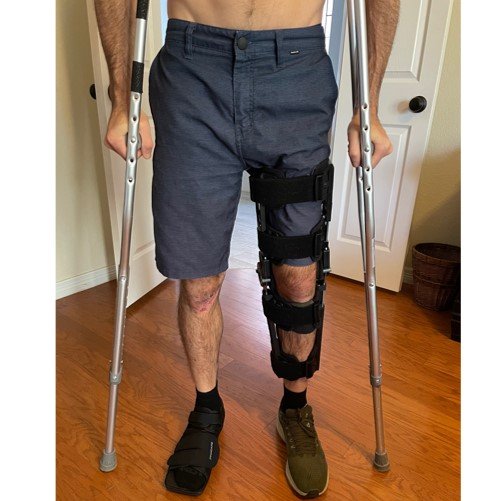 Broken foot in attractive new footwear.