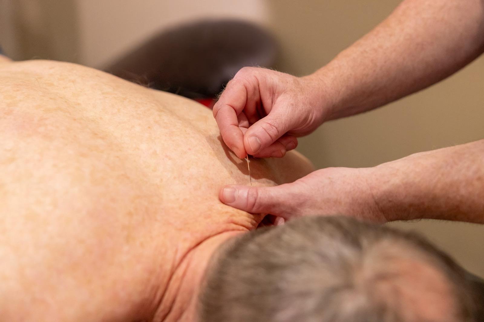 Person receiving acupuncture treatment with thin needles being inserted into their back.