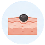 Cross-section of skin showing layers and a black mole on the surface