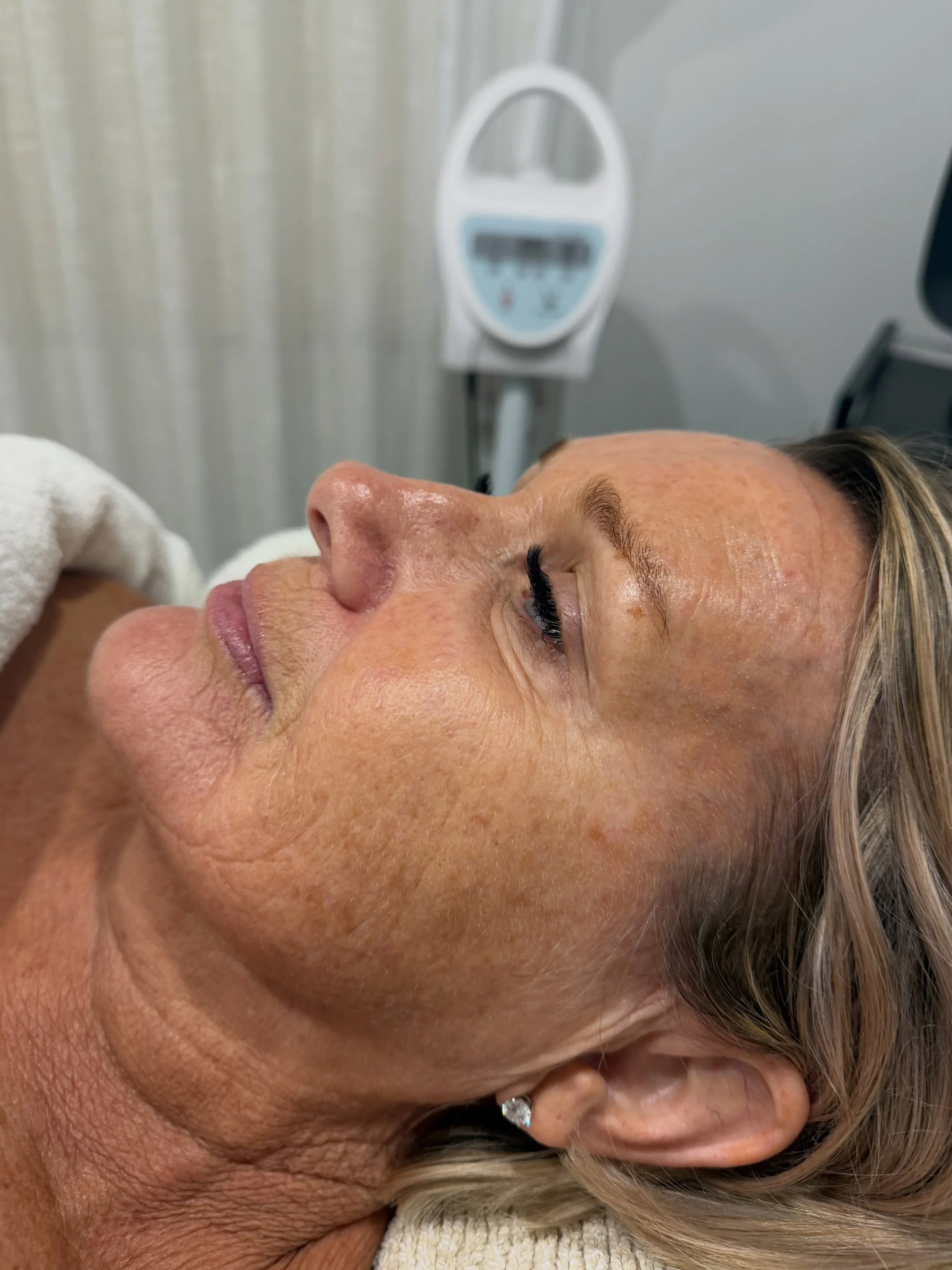 This is what a Pro2lift facial can do! Just two in 4 weeks gave these amazing results and the best part is there is absolutely no downtime. 
If you want to see how it happens, we do have a few spots left for our Red carpet launch event on Thursday 30