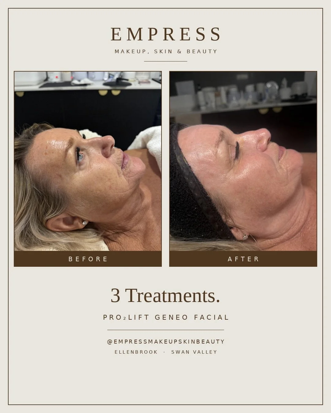 Three Pro₂Lift Geneo Facials. That&rsquo;s it. ✨

Look at the clarity through the cheek, the softness in the texture, and how much more hydrated and plump the skin looks. The Pro₂Lift works by oxygenating the skin from within &mdash; exfoliating, inf