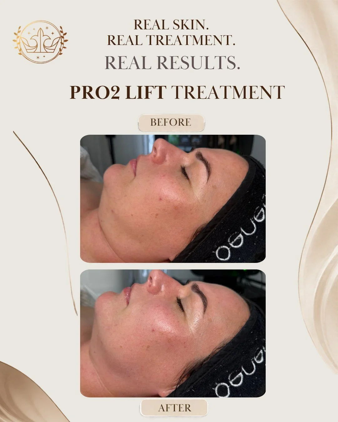 Look closely at this Pro₂Lift Before &amp; After.

Following the treatment, the skin appears more radiant and refreshed, with a smoother-looking complexion and a beautiful, healthy-looking glow.

Pro₂Lift combines advanced technologies designed to wo