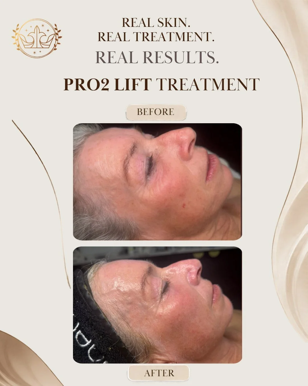 What consistency and professional skin treatments can support.
Real skin. Real treatment. Real results.

Look at the difference following this Pro₂Lift treatment. The skin appears more radiant and refreshed, with a smoother-looking complexion and a d