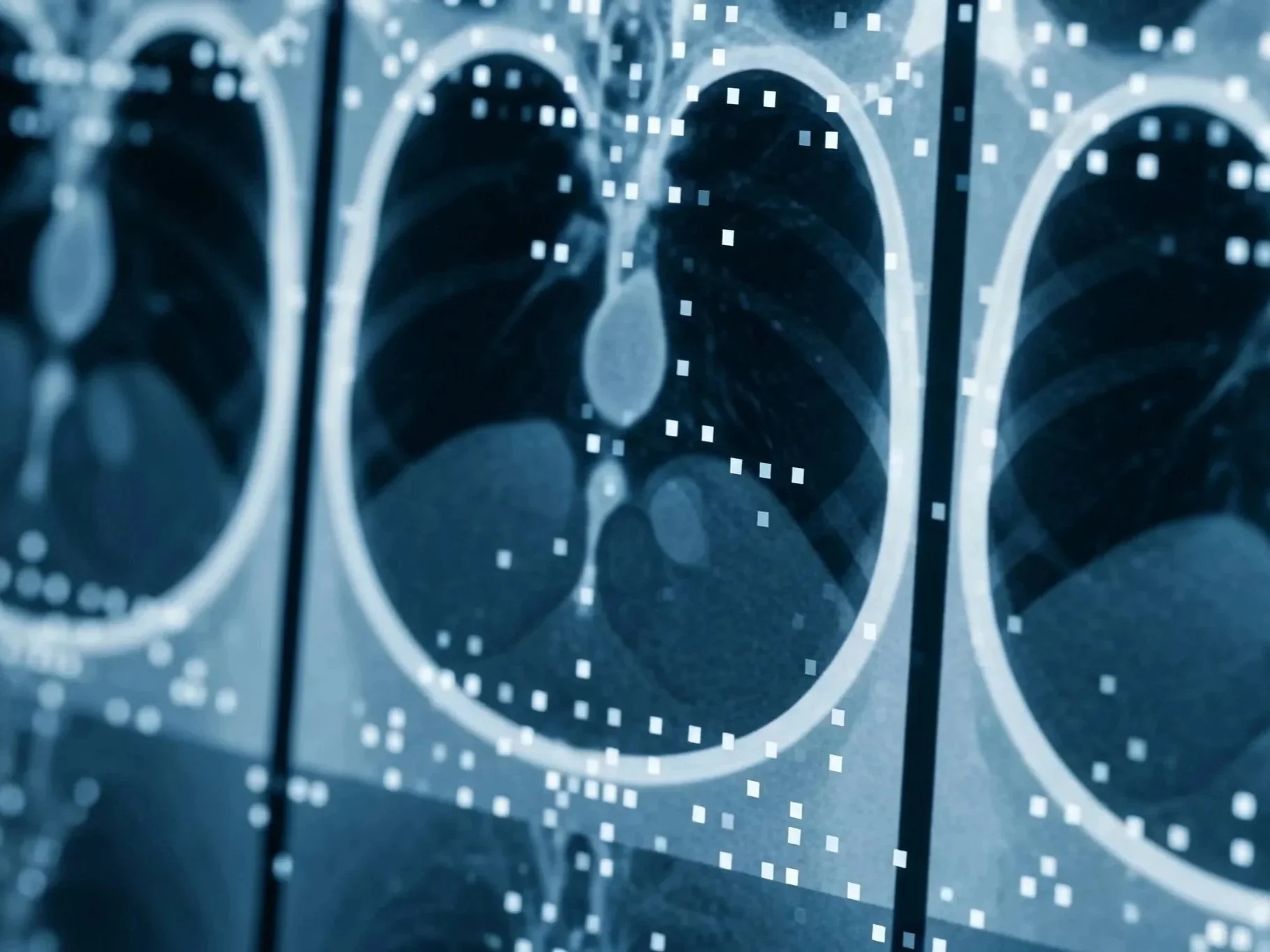 Lung Microbiome