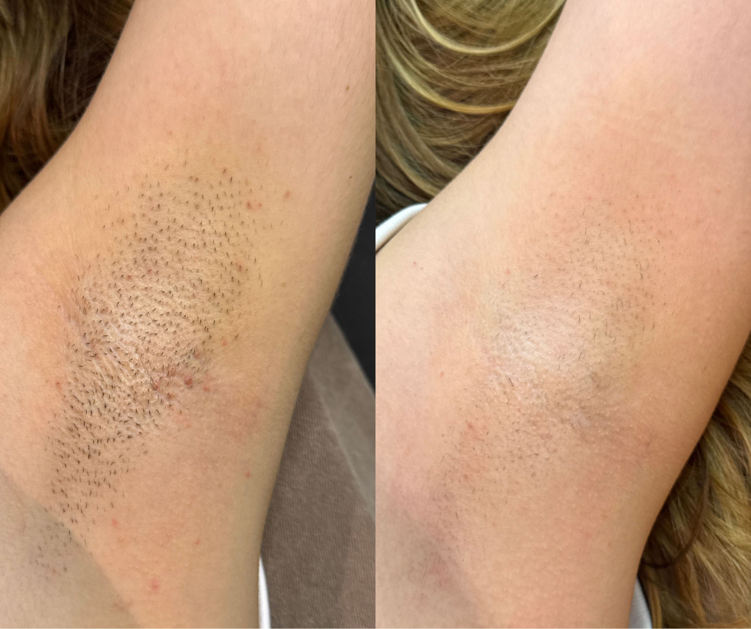 Comparison of armpit hair removal: left side shows hair stubble and irritation, right side shows smooth, hairless skin.