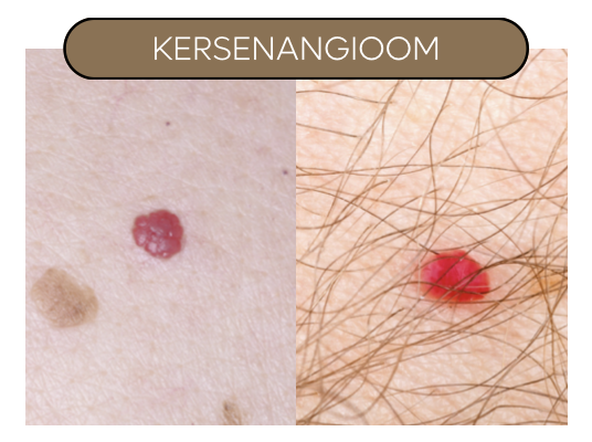 Kersenangioom, rubyspot