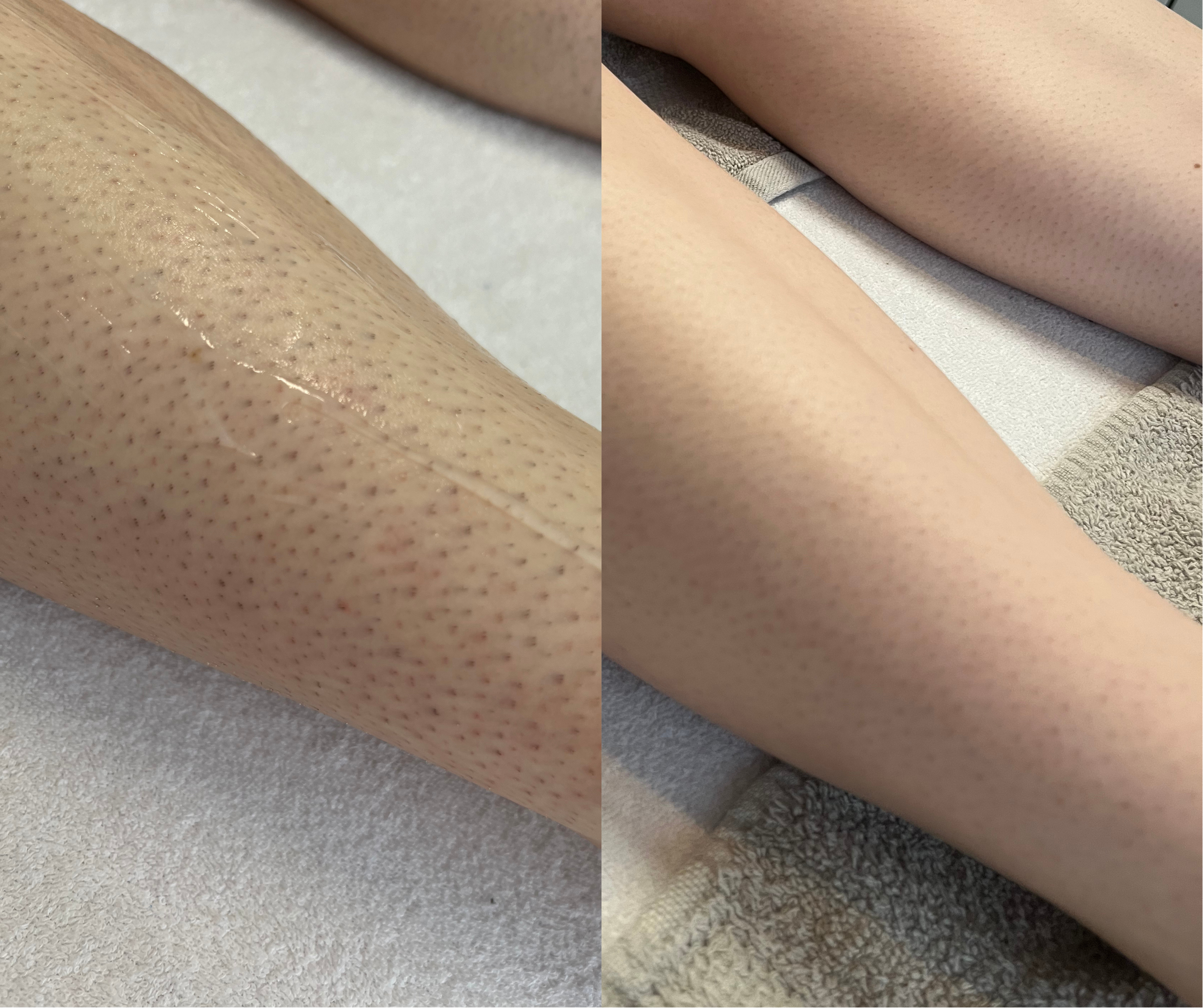 Close-up of two legs before and after hair removal with visible hair follicles on the left and smooth skin on the right.