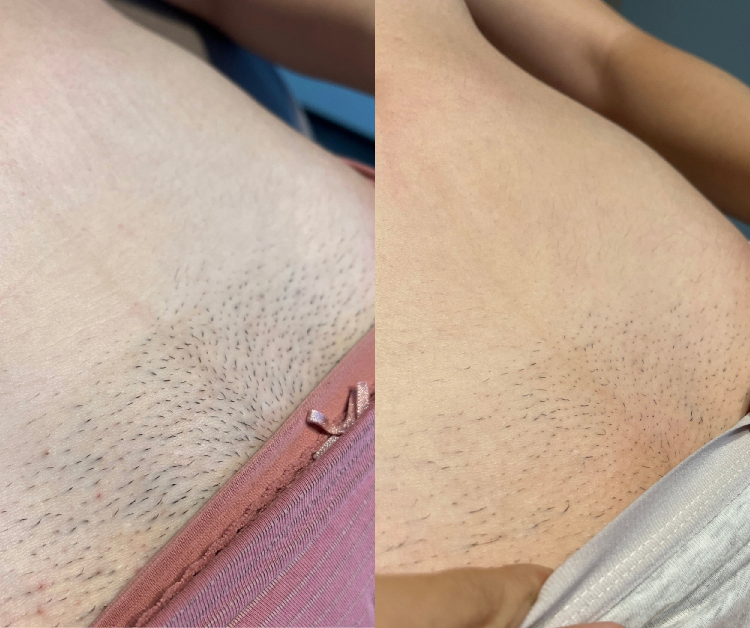 Close-up of a person's lower abdomen showing shaved area with stubble before and after shaving, with the left side showing stubble and the right side showing smooth skin.