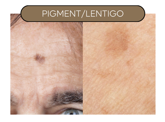 Pigmentvlekken/Lentigo