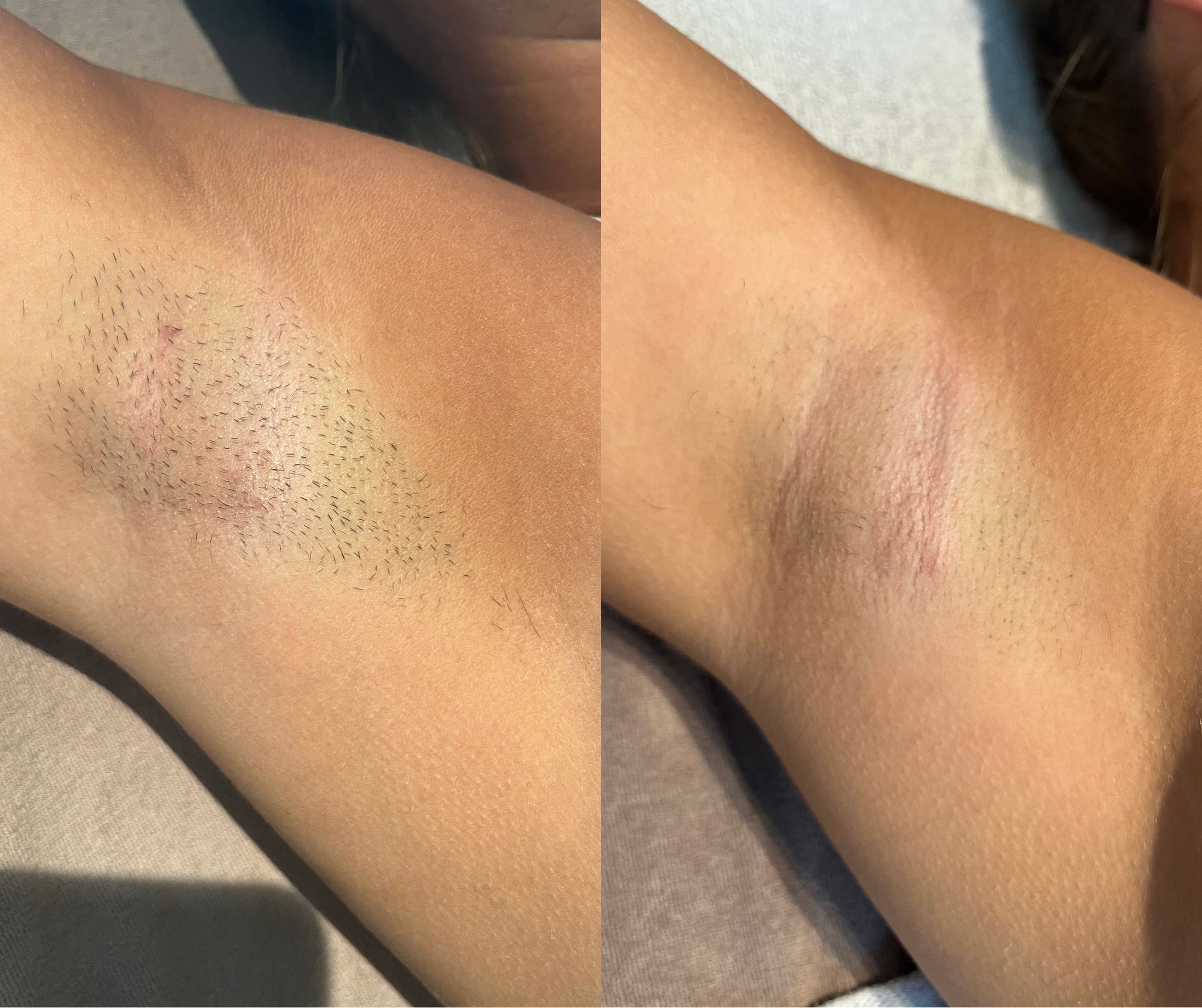 Comparison of armpits before and after hair removal: left shows armpit with visible hair stubble and slight irritation; right shows clean, hairless armpit with smooth skin.