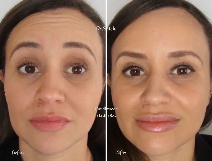 Side-by-side comparison of a woman before and after a cosmetic treatment. The before photo shows her with slightly uneven skin tone and fine lines. The after photo shows smoother skin, more even complexion, and glossy lips.