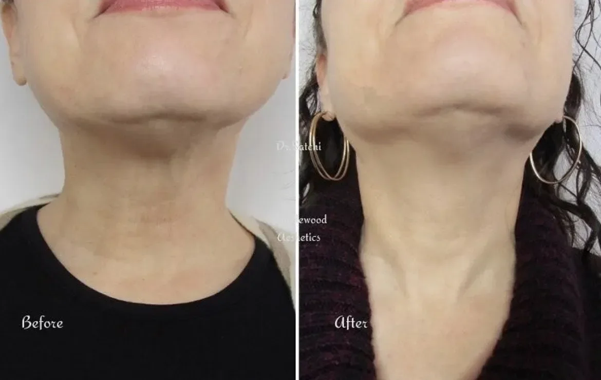 BOTOX NECK
