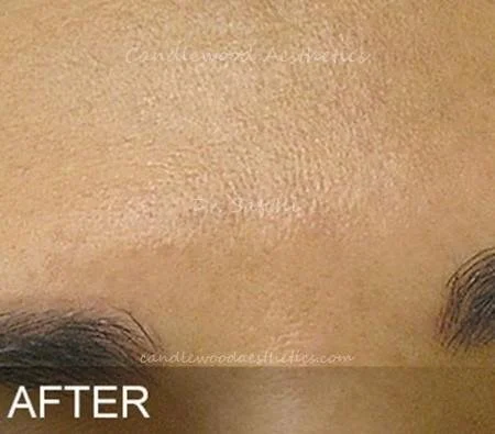 Close-up of a person's forehead with smooth, clear skin, labeled 'AFTER'.