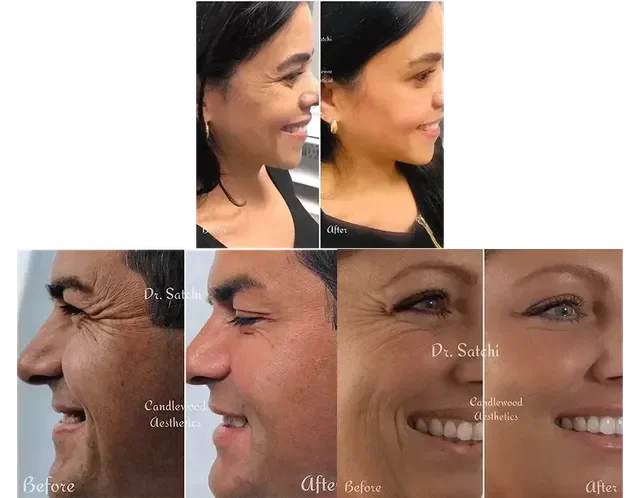 BOTOX CROWSFEET