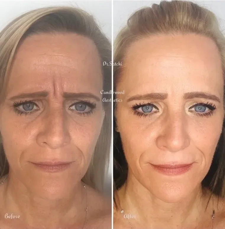 Side-by-side images of a woman's face showing a before-and-after comparison of facial rejuvenation. The 'before' image shows her with visible wrinkles and uneven skin tone, while the 'after' image shows smoother skin, reduced wrinkles, and a more you