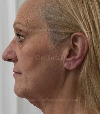 Close-up profile of an elderly woman's face, showing her skin and wrinkles.