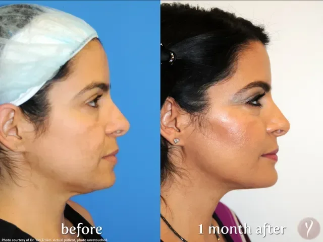 Side-by-side comparison of a woman before and one month after skincare treatment. The left image shows her with clearer skin, and the right shows her with more glow and improved skin texture.
