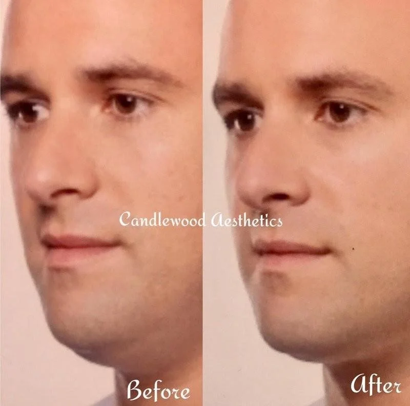 Side-by-side comparison of a man's face showing a before and after cosmetic procedure; 'Before' on the left and 'After' on the right, with the logo 'Candlewood Aesthetics' across the center.