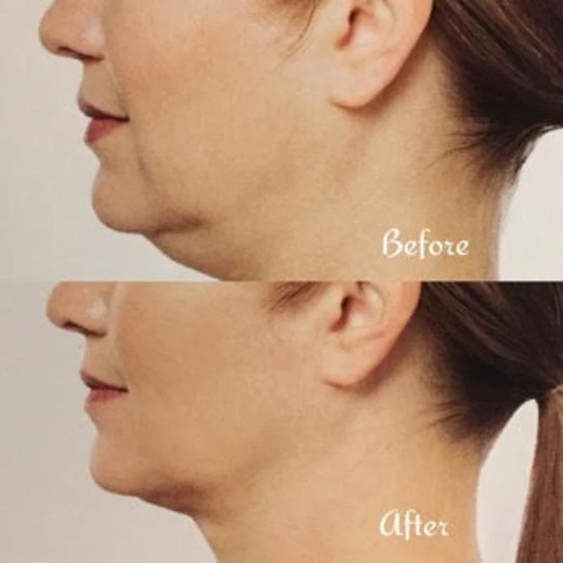 Side-by-side comparison of a woman’s jawline and neck showing before and after a cosmetic procedure to reduce double chin, with the top labeled "Before" and the bottom labeled "After."