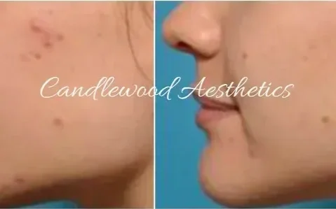 Close-up of a person's face showing a before-and-after comparison of skin improvement.
