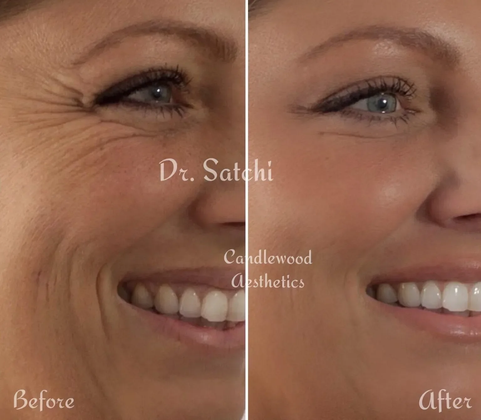 Side-by-side comparison showing a woman's face 'before' and 'after' wrinkle reduction, smiling with visible improvement in skin smoothness around eyes and cheeks, with the text 'Dr. Satchi Candlewood Aesthetics' in the center.