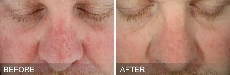 Close-up of a person's nose before and after skin treatment, showing reduced redness and improved skin tone in the after image.