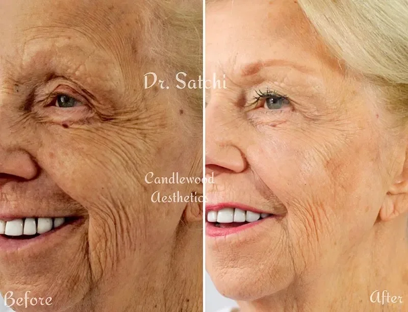 Comparison of elderly woman's face before and after aesthetic treatment showing reduced wrinkles, smoother skin, and enhanced appearance.