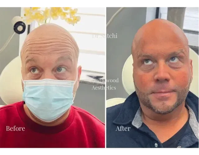 Side-by-side comparison of a man's face before and after a skin treatment, showing a reduction in forehead wrinkles and skin redness, with the man wearing a medical mask in the before image.