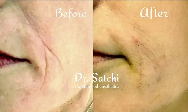 Close-up side-by-side comparison of a person's face showing a before and after of skin treatment; the before image displays wrinkles and dry skin, while the after image shows smoother skin with reduced wrinkles.