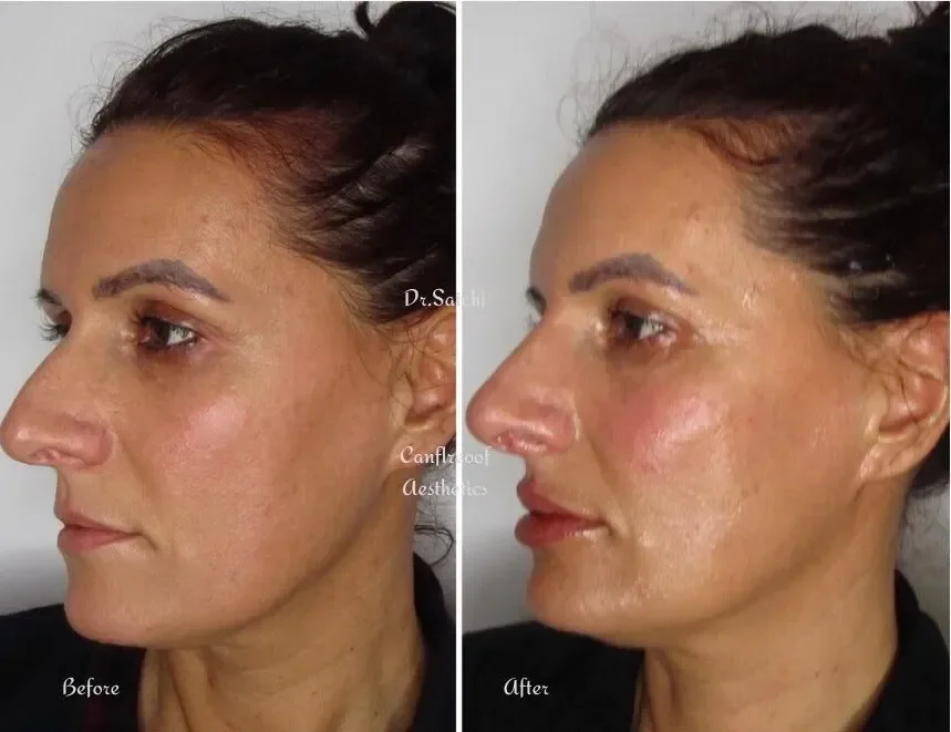 Side-by-side comparison of a woman's face showing her skin condition before and after a skincare treatment. The 'before' image shows less clear, more uneven skin tone, while the 'after' image shows smoother, more radiant skin.