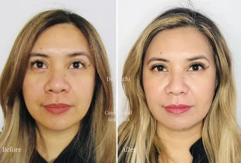 Side-by-side comparison of a woman before and after cosmetic treatments showing improved skin, makeup, and hairstyle.