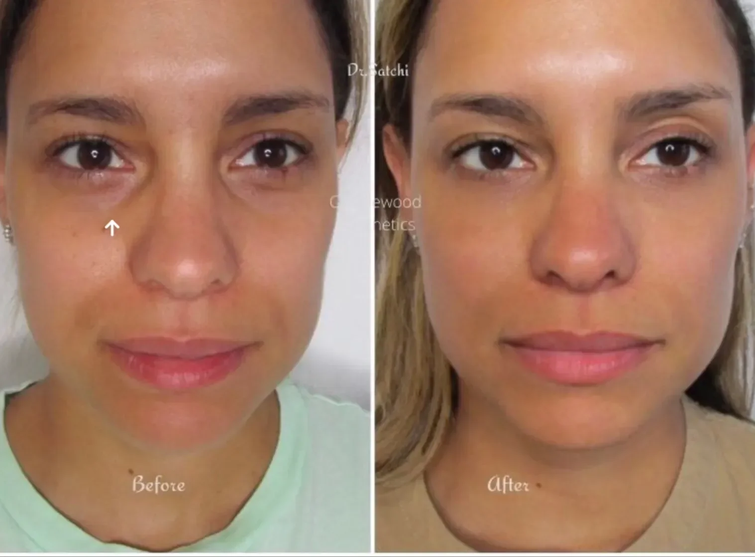Side-by-side comparison of a woman's face showing before and after skincare treatment. The left side shows her with some redness, under-eye puffiness, and uneven skin tone. The right side shows her with clearer, smoother skin, less redness, and a mor