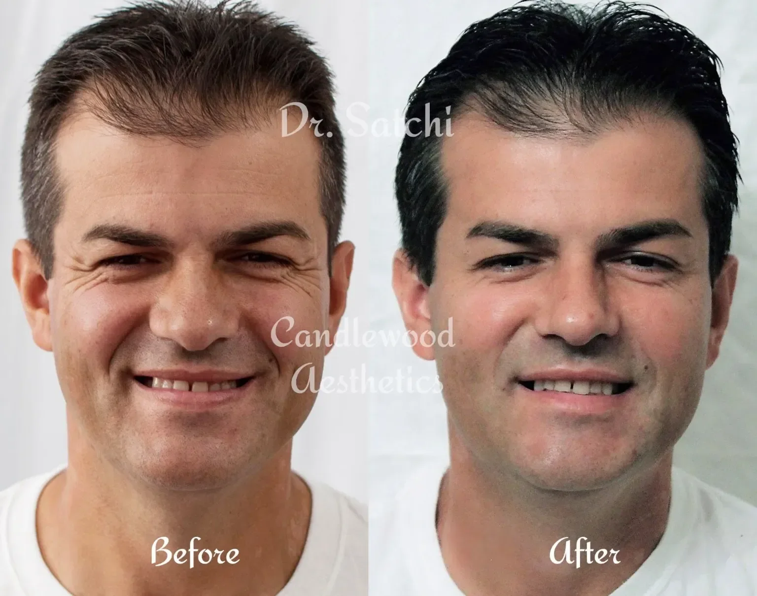 Side-by-side comparison of a man before and after facial treatment, smiling in both images. The before image shows him with short brown hair and missing a tooth, while the after image shows him with styled dark hair and a complete set of teeth.