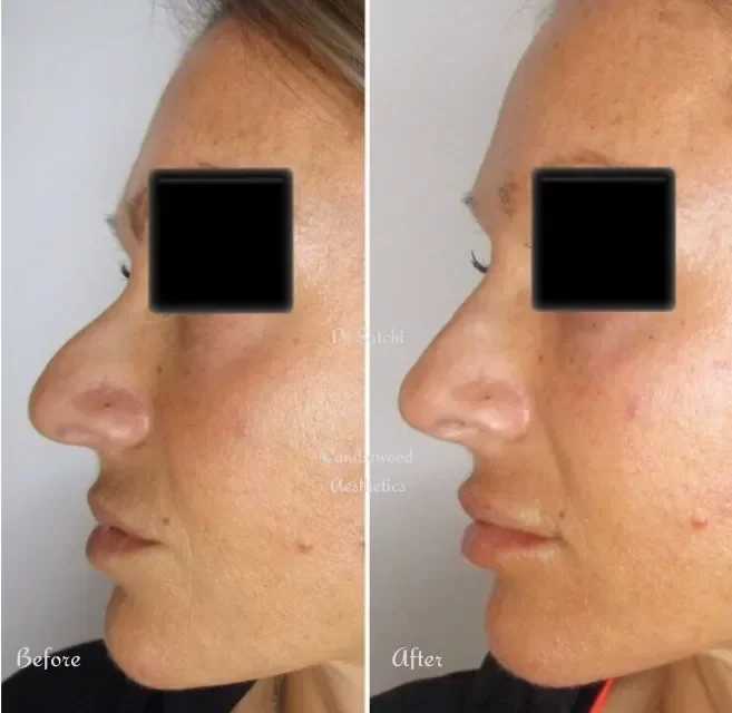 Side-by-side comparison of a woman's face showing before and after skin treatment, highlighting improvements in skin texture and acne reduction